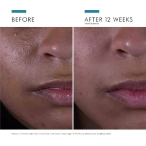 Skinceuticals silymarin cf anti imperfection serum with vitamin C is specially formulated for skin with oily and/or imperfections tendencies. It reduces skin oiliness and unclogs pores while improving the texture of the complexion.