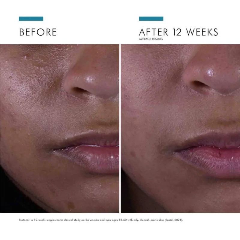 Skinceuticals silymarin cf anti imperfection serum with vitamin C is specially formulated for skin with oily and/or imperfections tendencies. It reduces skin oiliness and unclogs pores while improving the texture of the complexion.
