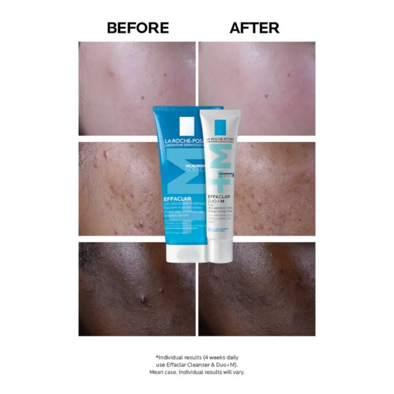 La Roche-Posay Effaclar Duo+M Anti-Imperfections Triple Corrective Care 40ml 1.4 fl. oz  - Before and After