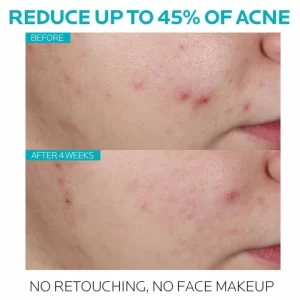 La Roche Posay Effaclar Ultra Concentrated Serum Before and After