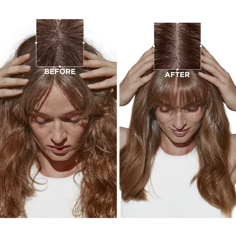 Kérastase symbiose micro-peeling cellular treatment for sensitive scalp prone to dandruff - Before and After