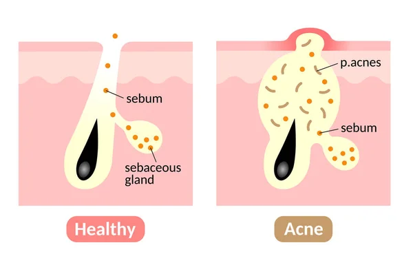 Formação de acne