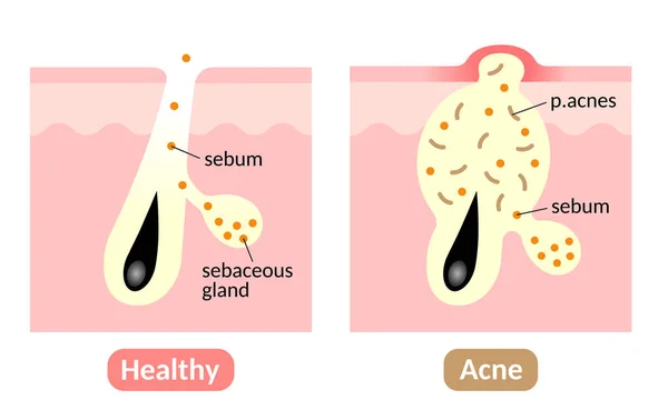 Acne foramation