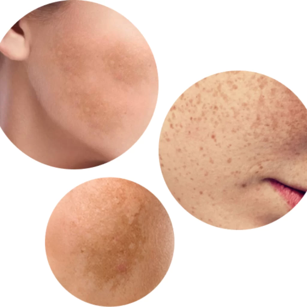 38F history of acne, beginning fine lines, and sun spots