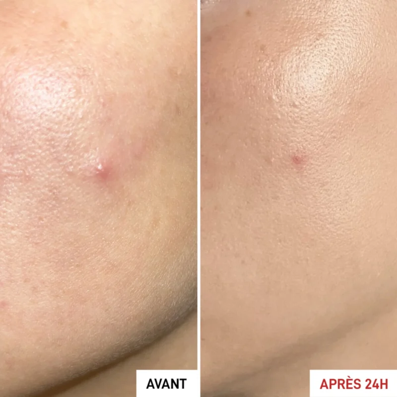 Erborian Centella SOS Anti-Imperfections Patch-Effect Gel 9ml - Before and After